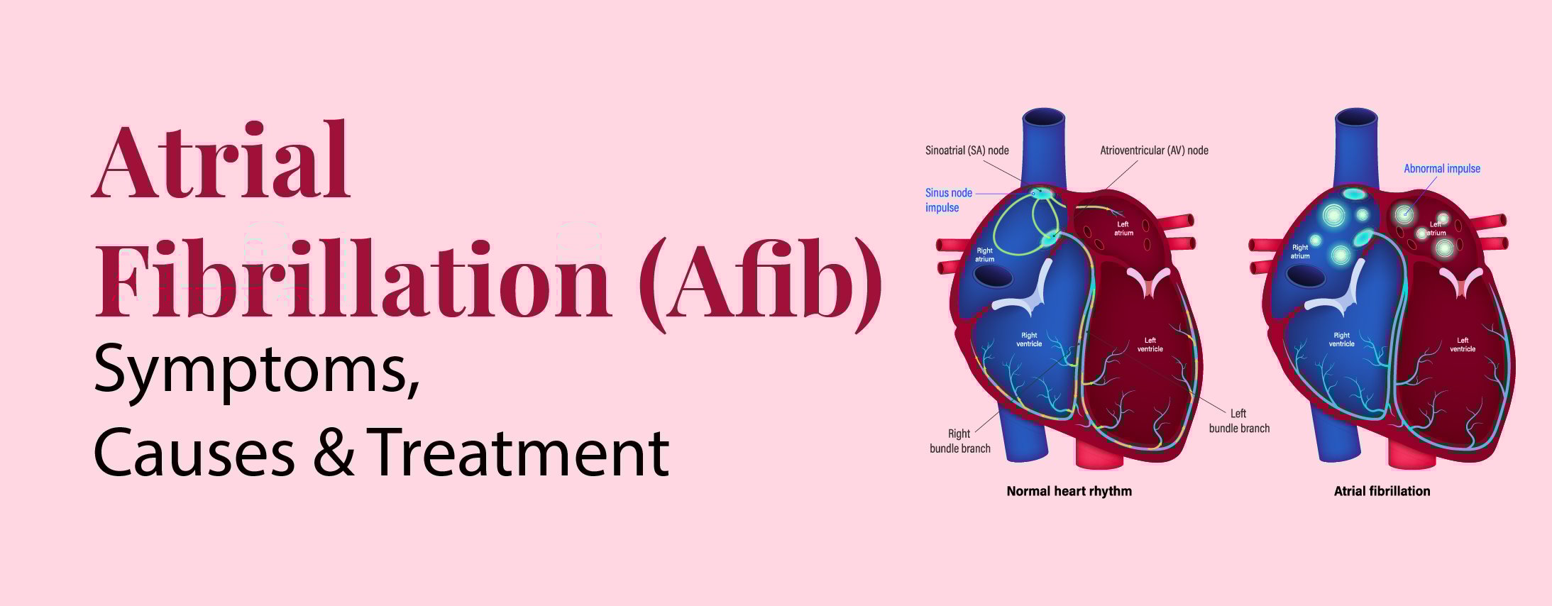 Atrial Fibrillation (Afib): Symptoms, Causes and Treatment Atrial Fibrillation (Afib): Symptoms, Causes and Treatment