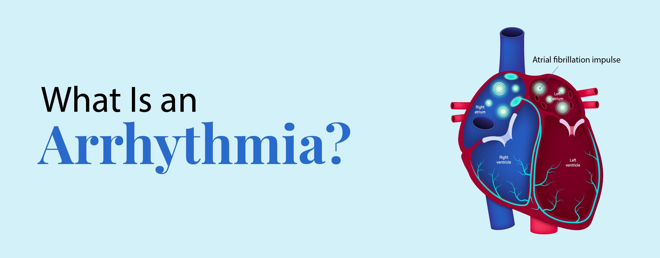 What is an Arrhythmia? What is an Arrhythmia?