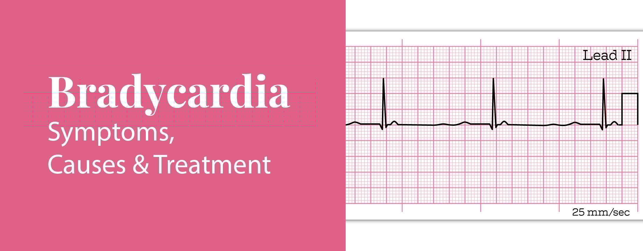 Bradycardia: Symptoms, Causes and Treatment Bradycardia: Symptoms, Causes and Treatment