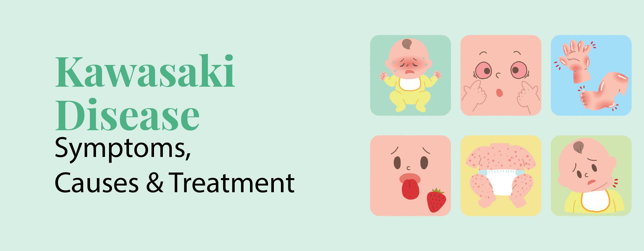 Kawasaki Disease: Symptoms, Causes and Treatment Kawasaki Disease: Symptoms, Causes and Treatment