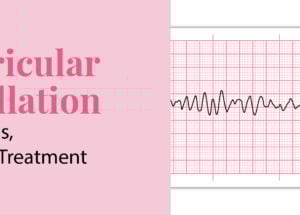 Ventricular Fibrillation: Symptoms, Causes and Treatment