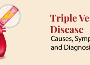 Triple Vessel Disease: Causes, Symptoms, and Diagnosis