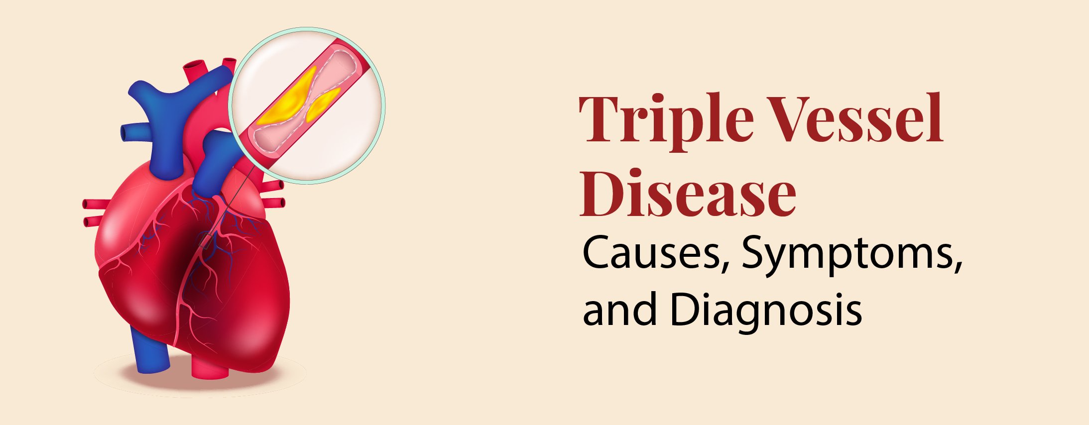 Triple Vessel Disease: Causes, Symptoms, and Diagnosis Triple Vessel Disease: Causes, Symptoms, and Diagnosis
