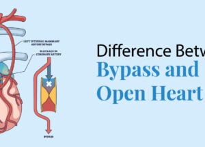 Difference Between Bypass and Open Heart Surgery