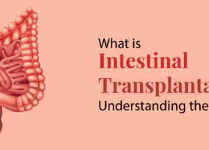 What is Intestinal Transplantation? Understanding the Procedure
