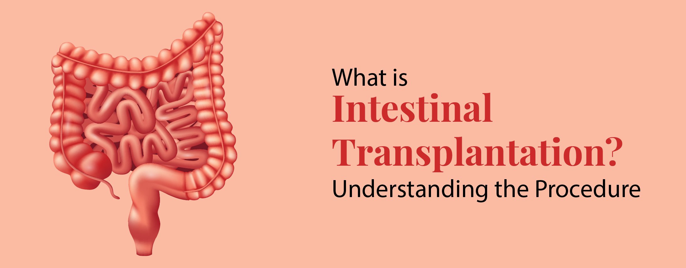 What is Intestinal Transplantation? Understanding the Procedure What is Intestinal Transplantation? Understanding the Procedure