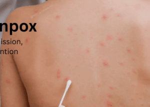Chickenpox: Causes, Transmission, Stages, and Prevention