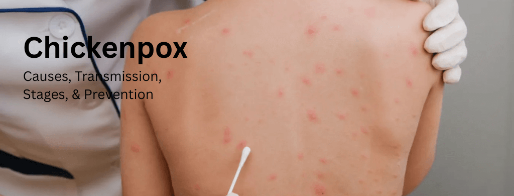Chickenpox: Causes, Transmission, Stages, and Prevention