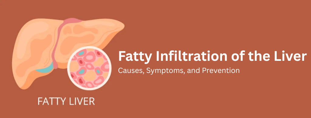 Fatty Infiltration of the Liver: Causes, Symptoms, and Prevention Fatty Infiltration of the Liver: Causes, Symptoms, and Prevention