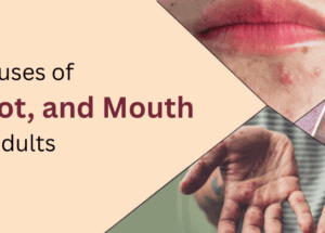 Hand, Foot, and Mouth Disease in Adults: Stages & Causes