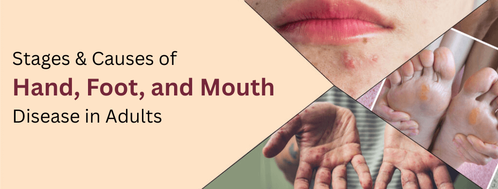 Hand, Foot, and Mouth Disease in Adults: Stages & Causes Hand, Foot, and Mouth Disease in Adults: Stages & Causes
