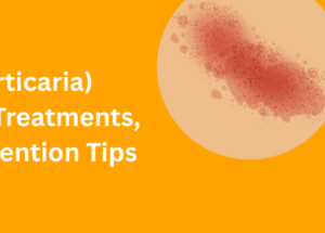 Hives (Urticaria): Causes, Treatments, and Prevention Tips