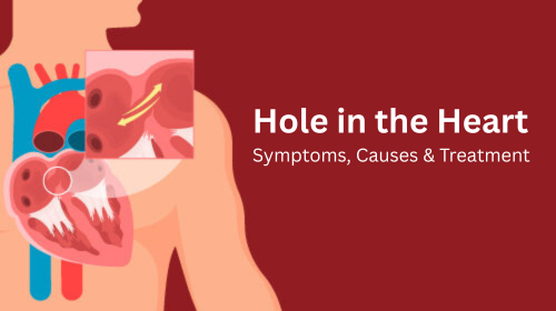 Hole in the Heart – Symptoms, Causes & Treatment Hole in the Heart – Symptoms, Causes & Treatment