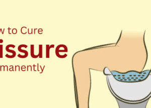 How to Cure Anal Fissure Permanently