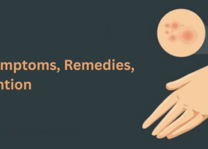 Ringworm: Causes, Symptoms, Remedies, and Prevention