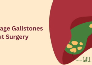How to Manage Gallstones Without Surgery