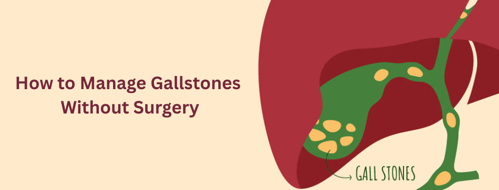 How to Manage Gallstones Without Surgery