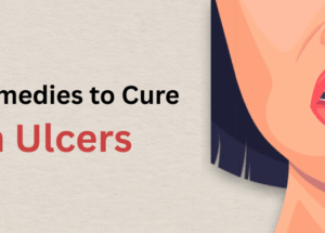 14 علاجًا منزليًا فعالًا لعلاج قرح الفم بسرعة