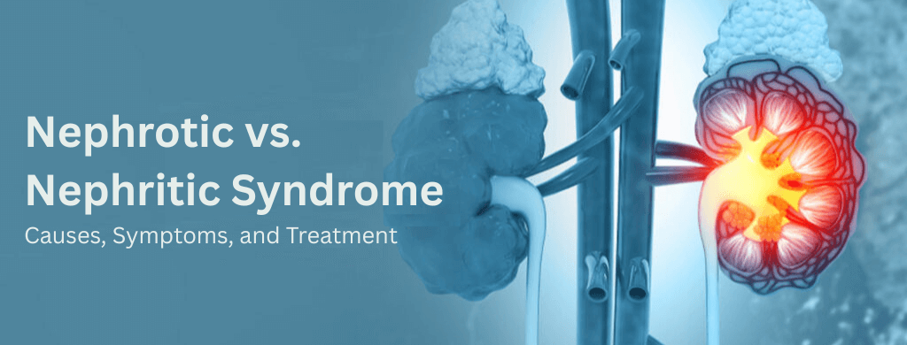 Nephrotic vs Nephritic Syndrome: Causes, Symptoms, and Treatment Nephrotic vs Nephritic Syndrome: Causes, Symptoms, and Treatment
