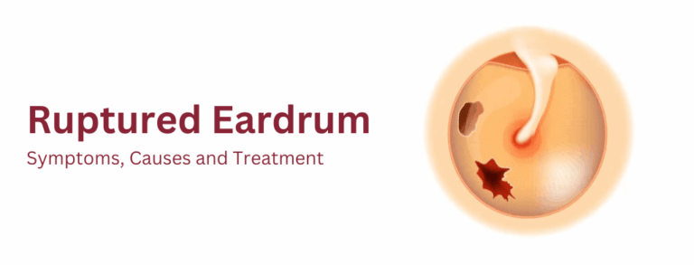 Ruptured Eardrum: Symptoms, Causes and Treatment