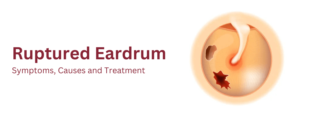 Ruptured Eardrum: Symptoms, Causes and Treatment Ruptured Eardrum: Symptoms, Causes and Treatment