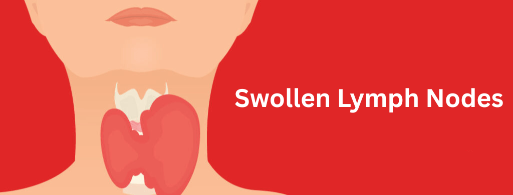 Swollen Lymph Nodes: Causes and Natural Treatments Swollen Lymph Nodes: Causes and Natural Treatments