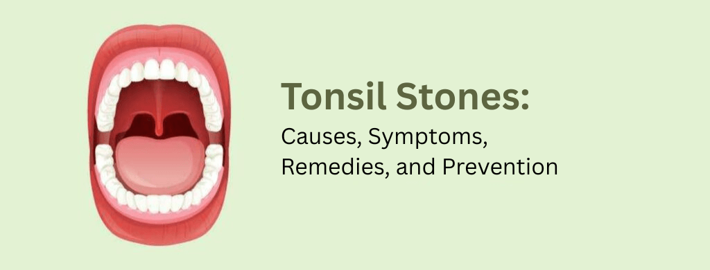 Tonsil Stones: Causes, Symptoms, Remedies, and Prevention Tonsil Stones: Causes, Symptoms, Remedies, and Prevention