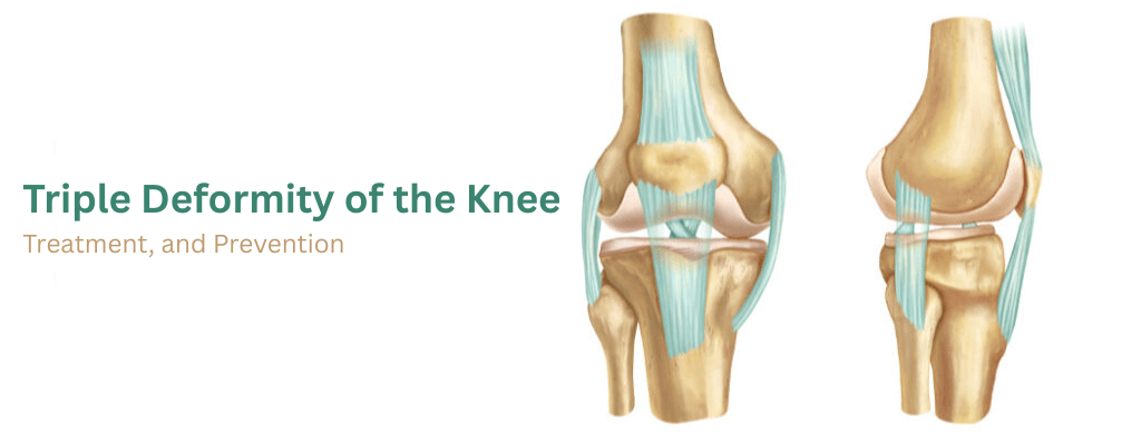 Triple Deformity of the Knee: Treatment, and Prevention Triple Deformity of the Knee: Treatment, and Prevention