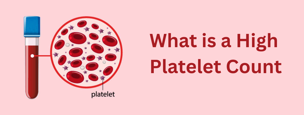What is a High Platelet Count? What is a High Platelet Count?