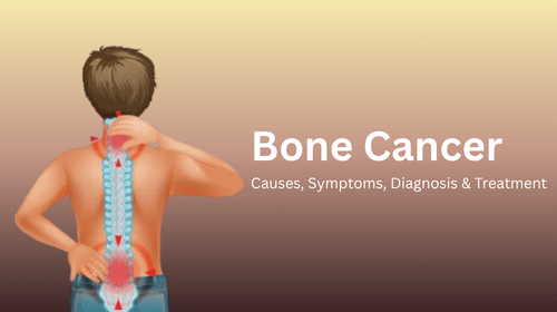 Bone Cancer: Causes, Symptoms, Diagnosis & Treatment