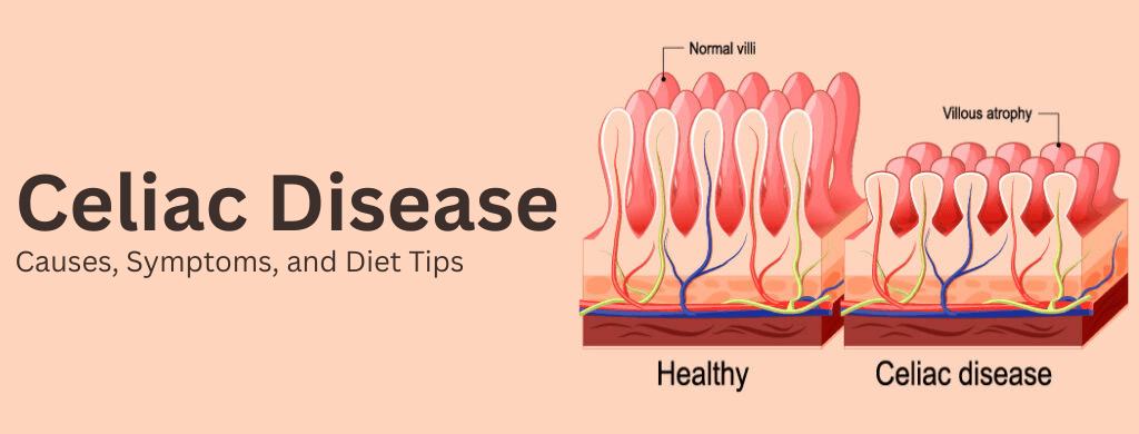 Celiac Disease: Causes, Symptoms, and Diet Tips Celiac Disease: Causes, Symptoms, and Diet Tips