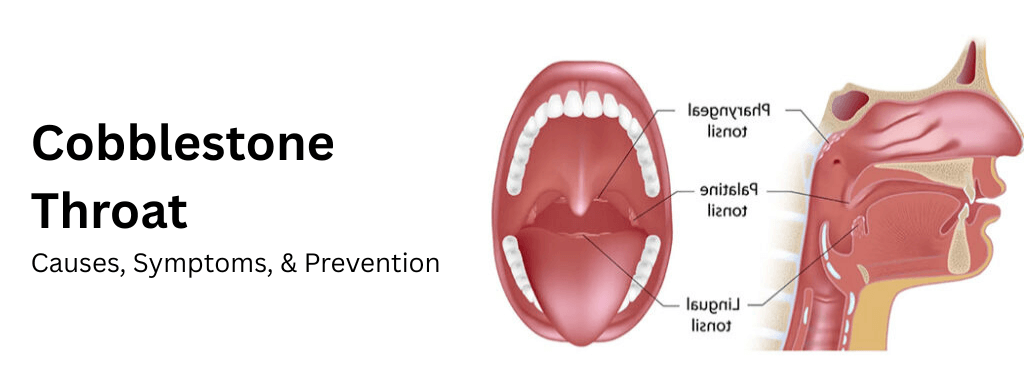 Cobblestone Throat: Causes, Symptoms, & Prevention Cobblestone Throat: Causes, Symptoms, & Prevention