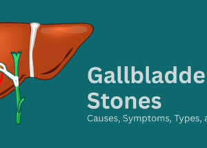 Gallbladder Stones: Causes, Symptoms, Types, and Treatment