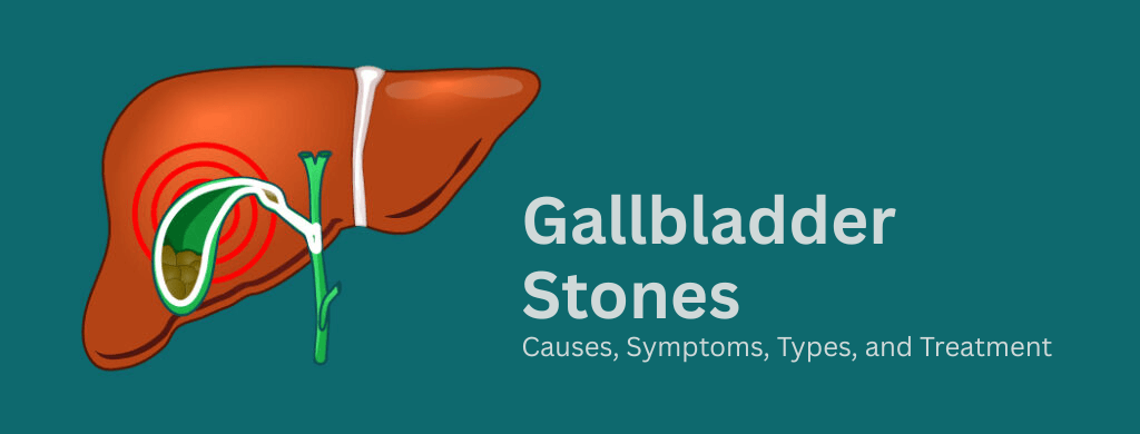 Gallbladder Stones: Causes, Symptoms, Types, and Treatment