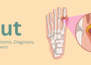 Gout: Causes, Symptoms, Diagnosis, and Management