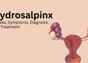 Hydrosalpinx: Causes, Symptoms, Diagnosis, and Treatment
