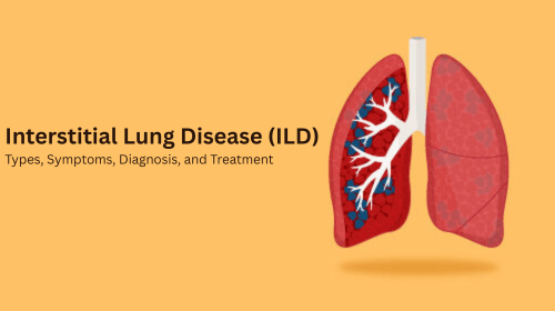 Interstitial Lung Disease (ILD): Types, Symptoms, Diagnosis, and Treatment