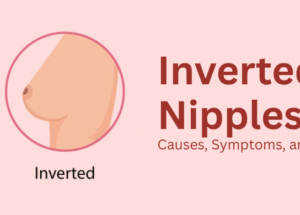 Inverted Nipples: Causes, Symptoms, and Treatment