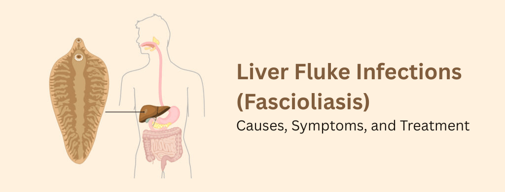 Liver Fluke Infections (Fascioliasis): Causes, Symptoms, and Treatment Liver Fluke Infections (Fascioliasis): Causes, Symptoms, and Treatment