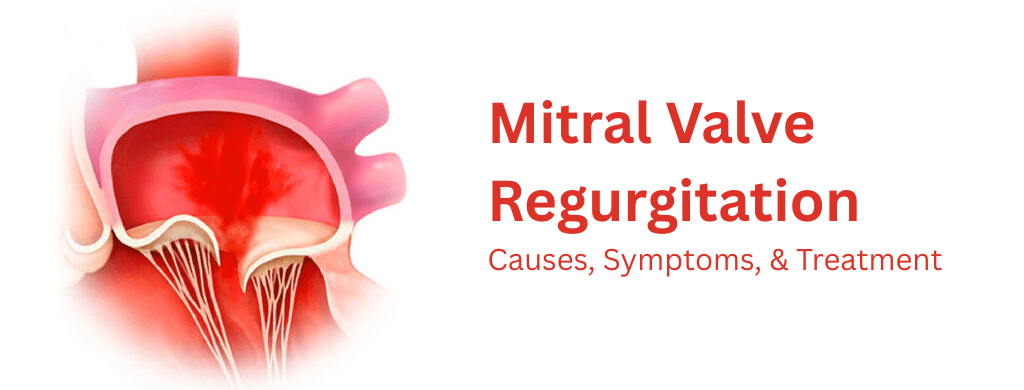 Mitral Valve Regurgitation: Causes, Symptoms, & Treatment Mitral Valve Regurgitation: Causes, Symptoms, & Treatment