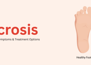 Necrosis: Causes, Types, Symptoms & Treatment Options