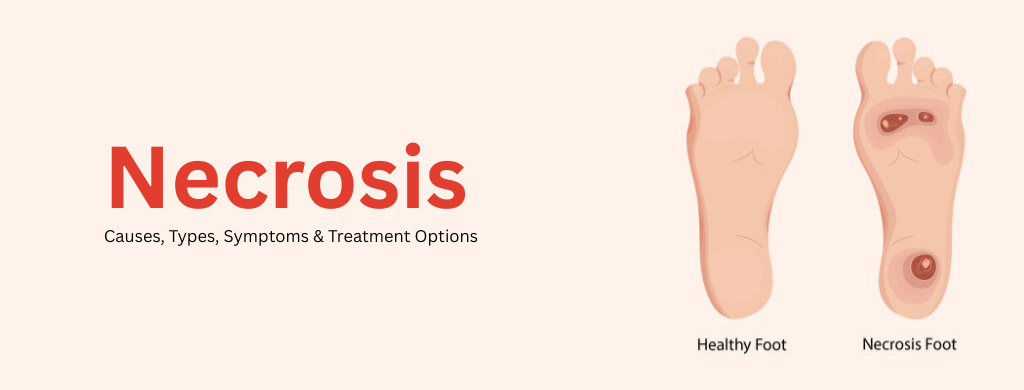 Necrosis: Causes, Types, Symptoms & Treatment Options Necrosis: Causes, Types, Symptoms & Treatment Options