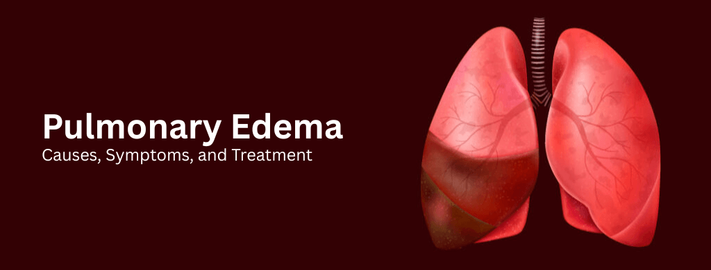 Pulmonary Edema: Causes, Symptoms, and Treatment Pulmonary Edema: Causes, Symptoms, and Treatment