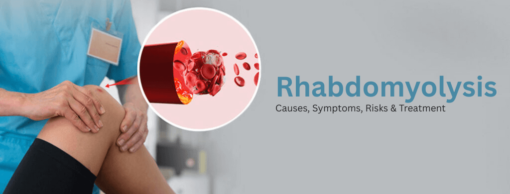 Rhabdomyolysis: Causes, Symptoms, Risks & Treatment Rhabdomyolysis: Causes, Symptoms, Risks & Treatment