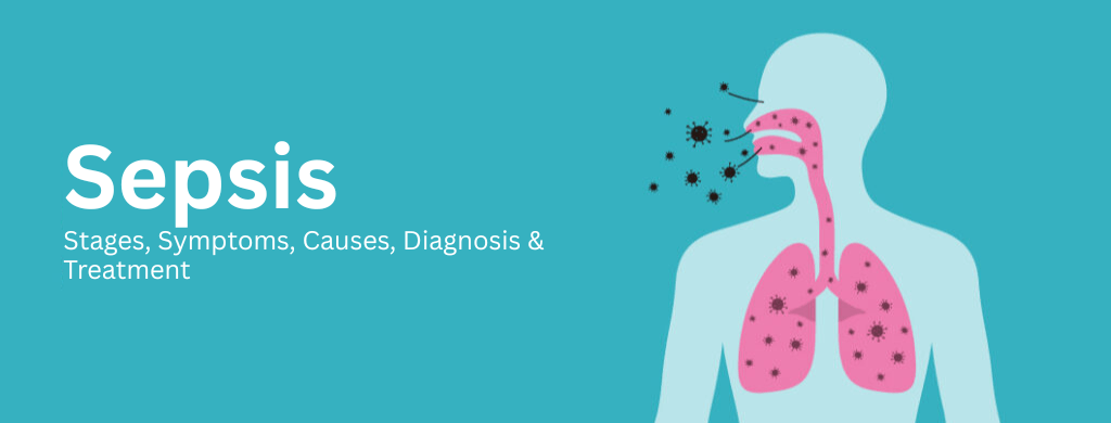 Sepsis: Stages, Symptoms, Causes, Diagnosis & Treatment Sepsis: Stages, Symptoms, Causes, Diagnosis & Treatment