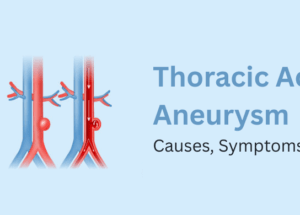 Thoracic Aortic Aneurysm: Causes, Symptoms, & Treatment