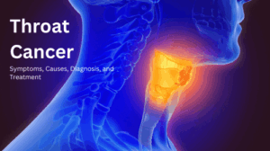 Throat Cancer: Symptoms, Causes, Diagnosis, and Treatment