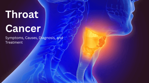 Throat Cancer: Symptoms, Causes, Diagnosis, and Treatment Throat Cancer: Symptoms, Causes, Diagnosis, and Treatment