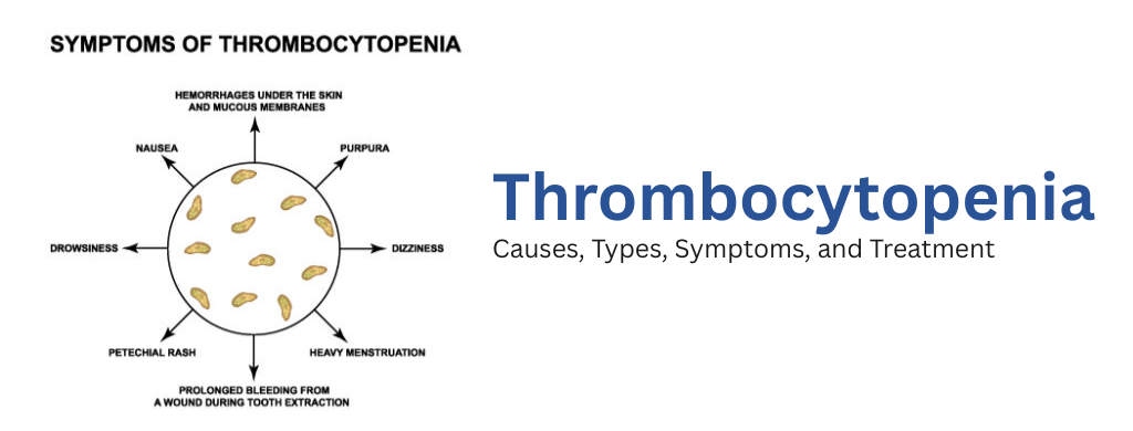 Thrombocytopenia: Causes, Types, Symptoms, and Treatment Thrombocytopenia: Causes, Types, Symptoms, and Treatment