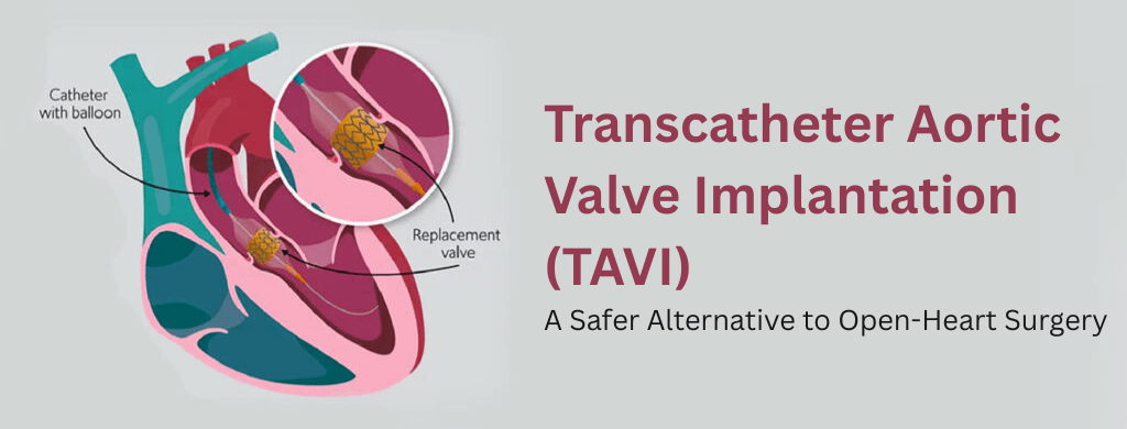 Transcatheter Aortic Valve Implantation (TAVI): A Safer Alternative to Open-Heart Surgery Transcatheter Aortic Valve Implantation (TAVI): A Safer Alternative to Open-Heart Surgery